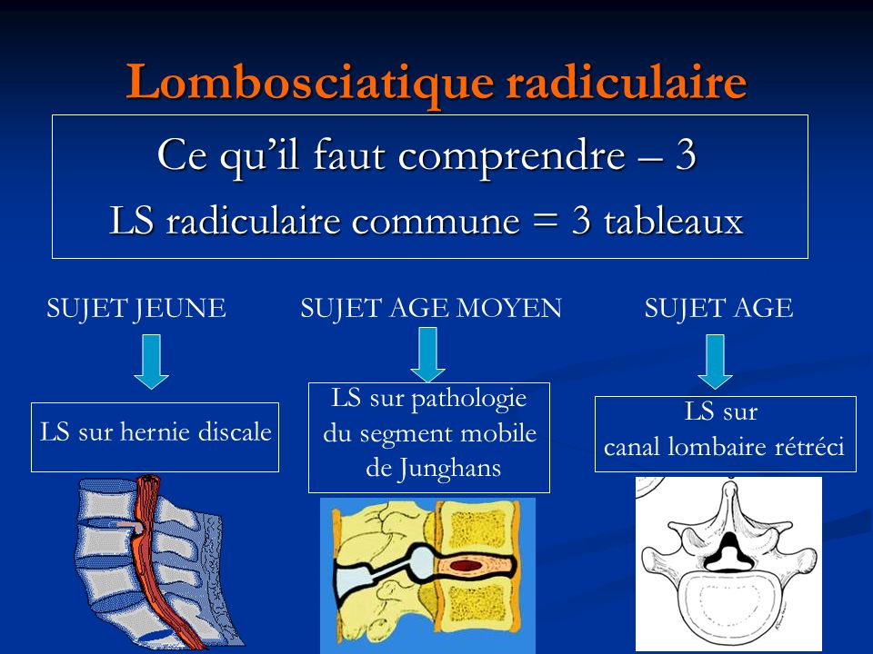 Radiculalgies. ppt video online t l charger